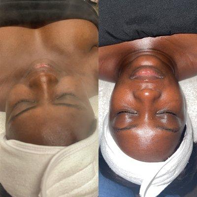 Deluxe Facial- Before & After Facial