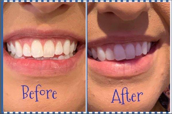 Results After A Session In Our Teeth Whitening Room - These Results Will Last 8-12 Months