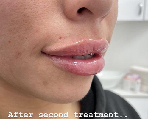 #lipfillers #juvederm #lipflip #russianlips #botox #BotoxInjection #botoxinjections