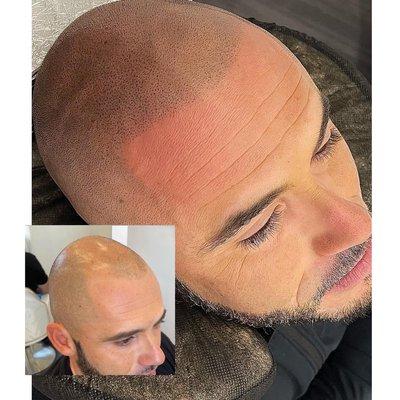 Scalp Micro Pigmentation for ultimate hair loss solution!