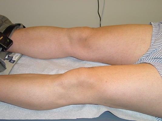 Full Legs Single Treatment