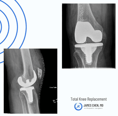 Total knee replacement is a surgical procedure performed to replace worn joint surfaces in the knee, usually due to severe arthritis.