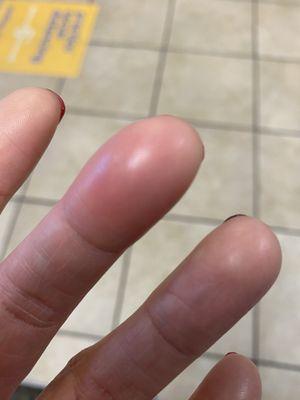 My finger that is infected after getting a manicure at this salon.