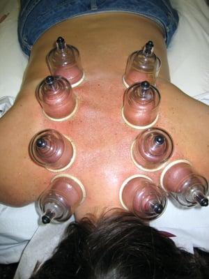 In our practice, we use cupping is it is indicated. It is much safer to use cupping with someone who is knowledgable in its use.