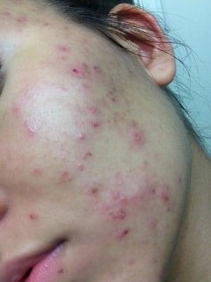 Before Accutane.