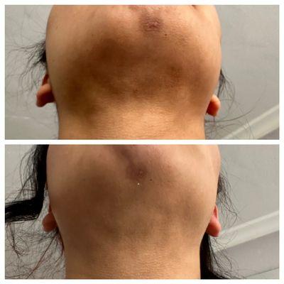 Chin lipo fibrosis treatment