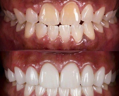 Porcelain veneers change color, shape and size of teeth