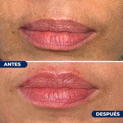 Before & After Lip Filler