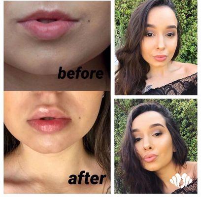 Juvederm lip fillers