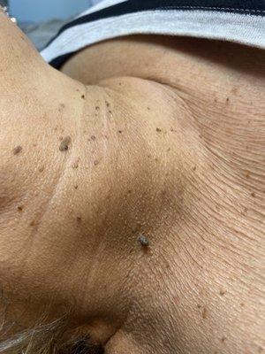 Skin tag removal