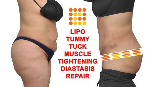 Lipo 360, tummy tuck, muscle tightening diastasis repair.