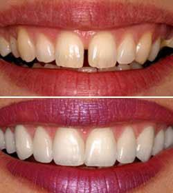 veneers