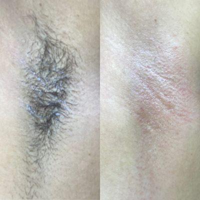 Armpit Wax Before & After