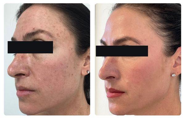 Facial brightening before & after