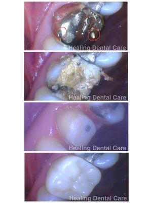 Gold Crown with Holes had Caused Extensive Cavity.  Treated with Root Canal, Post, Crown.