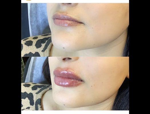 Lip fillers