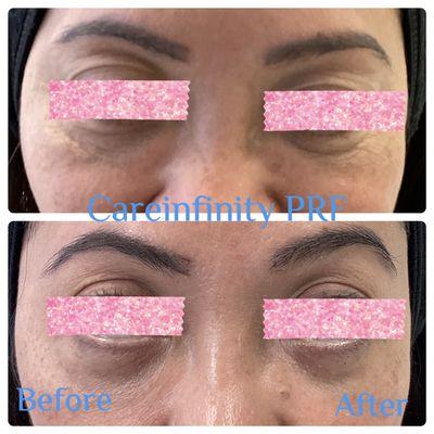 PRF Undereye treatment