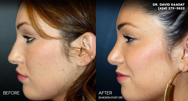 Recent Rhinoplasty Surgery Side View