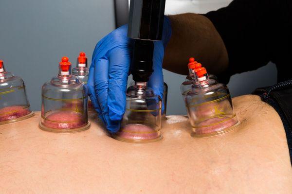 Cupping