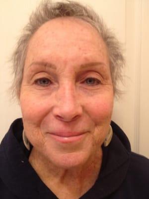 Cancer Patient, before picture Brows eyeliner and lips