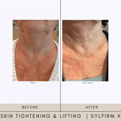 Skin Tightening Sylfirm x