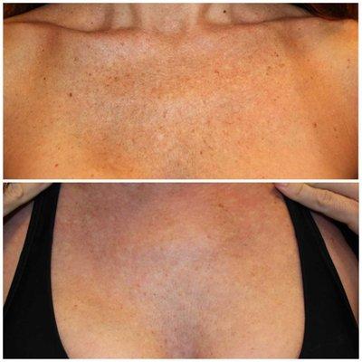 IPL (Intensed Pulse Light) by Heather Dahl, LMA. This photo was taken just 2 weeks after the first treatment.