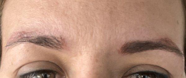 Eyebrows after first laser session 9/1/22