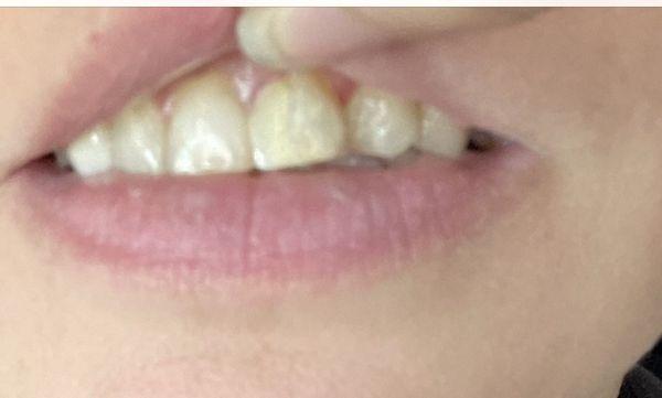 Right front tooth with the crack appearance clearly present and some discoloration.