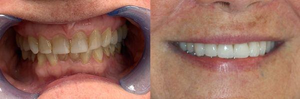 Veneers Before/After