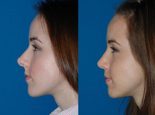 Rhinoplasty