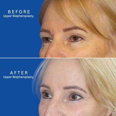 Upper  Blepharoplasty- Dr. Stompro