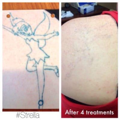 Strella specializes in Laser Tattoo Removal and our clients see amazing results!