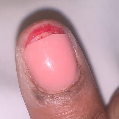 Ripped off nail