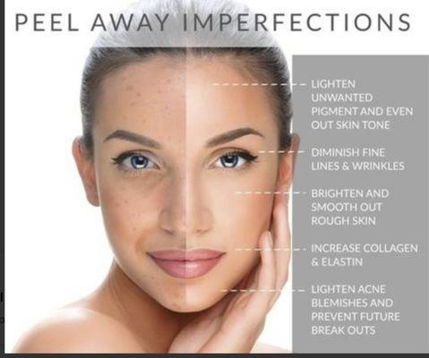 Chemical Peels can be a complete game changer for your skin!