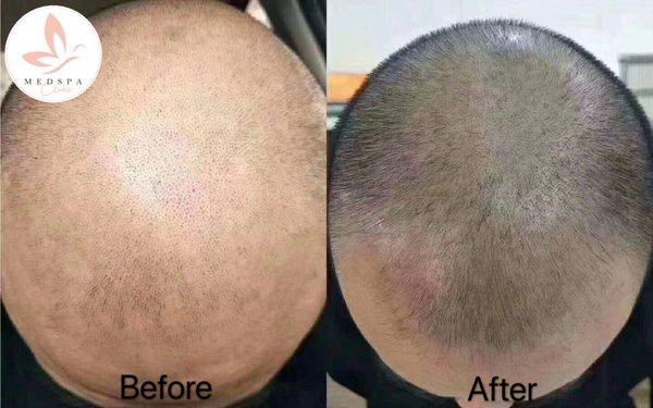 CO2 Hair Restoration treatment after 8 weeks-hair back