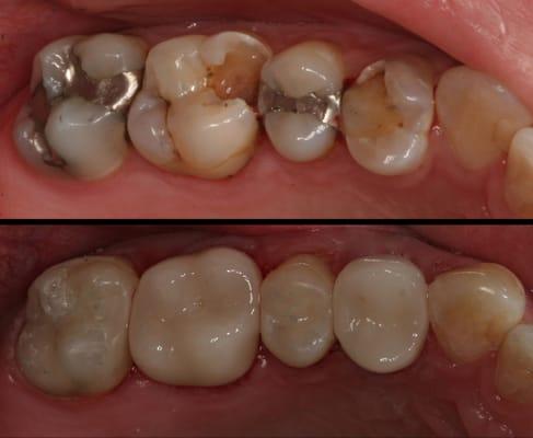 Restoration with CEREC and fillings.