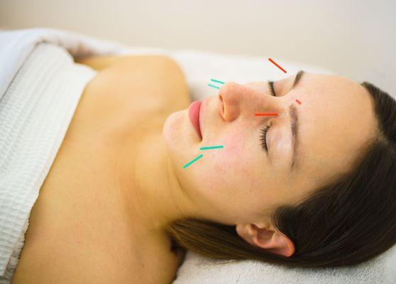 Cosmetic acupuncture erases fine lines and dramatically softens deep wrinkles. Plus you'll feel great and sleep better too!