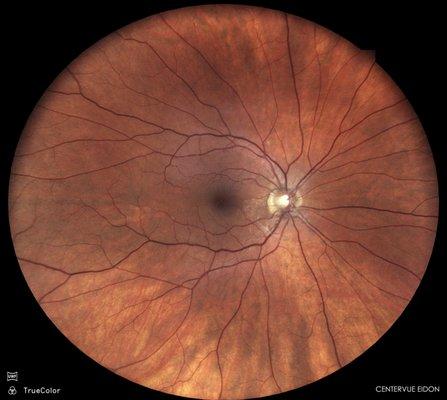 retinal vasculitis