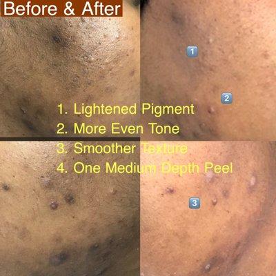 Patient great results following 1 medium depth medical grade chemical peel