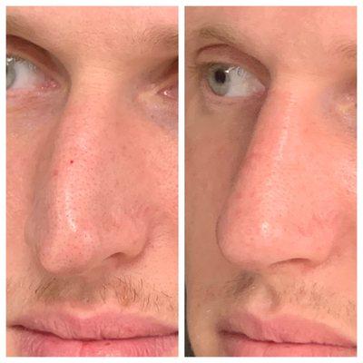 Rhinoplasty, by Dr. Tim Neavin