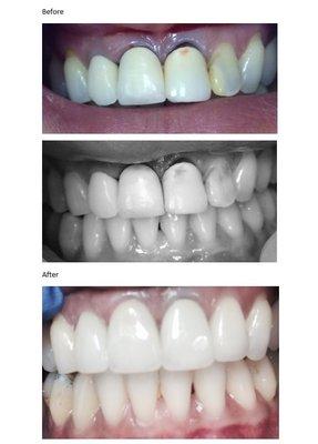 We changed out (top) two old porcelain-fused-metal crowns to four all-porcelain crowns for better symmetry,translucency and aesthetics!