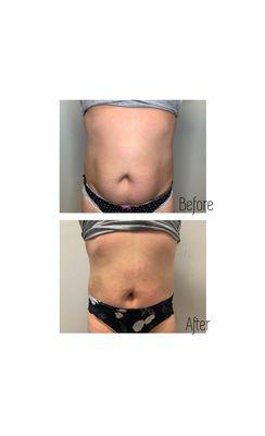 Body cavitation and RF treatment