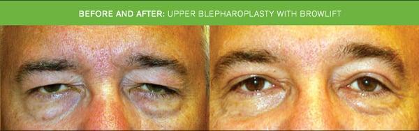 Before & After: Upper Blepharoplasty (Eyelift) with browlift