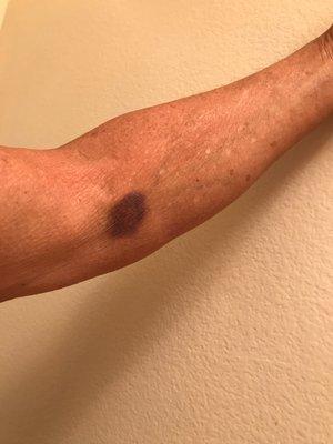 black & Blue mark on arm after blood draw