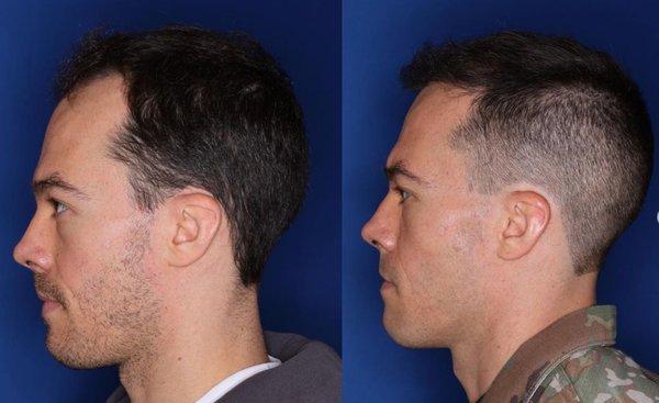 These photos are 8 months after post-transplant of 2000 grafts. It's only about 70% grown in, full results are seen at 18 months.