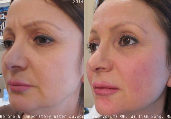 Juvederm Voluma Before and After by Dr. Song