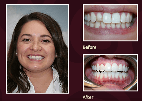 Gorgous & natural smile with minimal prep veneers(Lumineers)