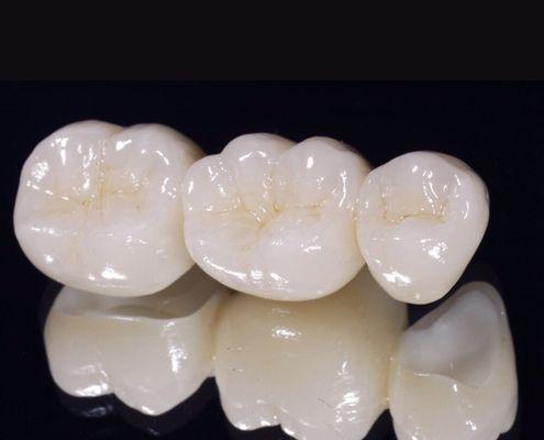 All ceramic dental restorations