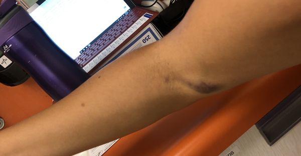 My arm 24hrs after blood was drawn.