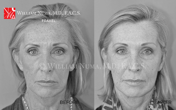 Fraxel targets: Fine lines and wrinkles, irregular skin texture, acne scars, stretch marks, post procedural scars.